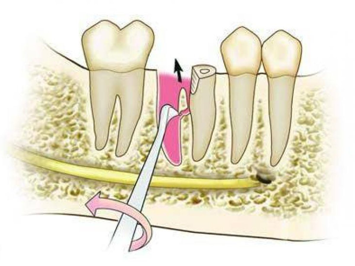 2 корня в зубе. Гемисекция резекция зуба. Зубная перегородка межкорневая. Межкорневой периодонтит. Гемисекция и ампутация корня зуба.